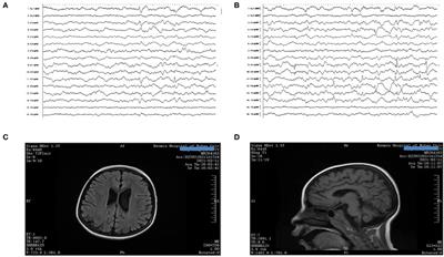 A Treatable Genetic Disease Caused by CAD Mutation